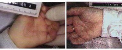 jonben-t-ramsey-autopsy-photos-hands_palms.jpg