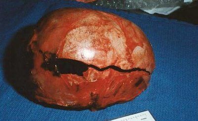 jonben-t-ramsey-autopsy-photos-crackedskull.jpg