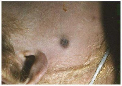jonben-t-ramsey-autopsy-photos-0jonbenetfaceop.jpg