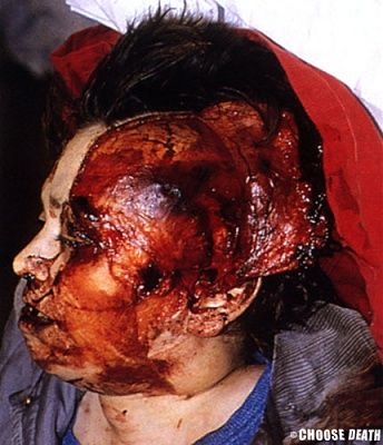 flaying-injury-traffic-accident.jpg