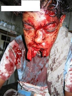 chin-blast-face-covered-blood-02-450x600.jpg