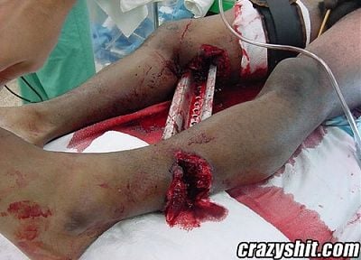 sign-leg-wound.jpg