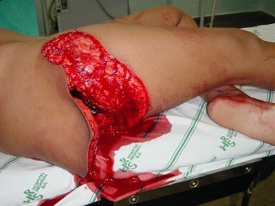 wound1.jpg