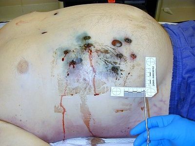 shotgun_wound_to_abdomen.jpg