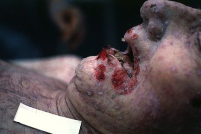 herpes-labialis.jpg