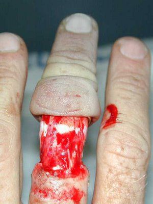 Degloved_finger_from_ring_1.jpg