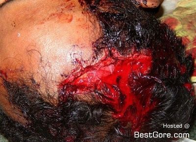 bombing-victim-01-500x363.jpg