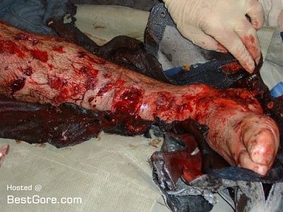 severe-leg-trauma-02-500x375.jpg