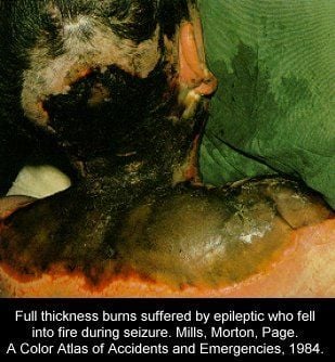 pic-ac-burn02.jpg