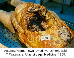 woman swallowed hydrochloric acid.jpg