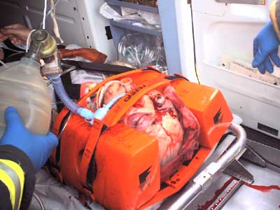 Retrobulbarhemorrhage~Writch.jpg