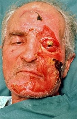 acidfacialandglobeburnsnotasbadasalkali_lefteyelost_0.jpg