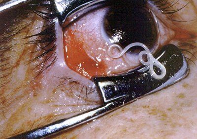 eyeworm024524003.jpg