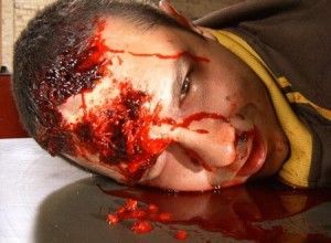 head-injury-blood-300x220.jpg