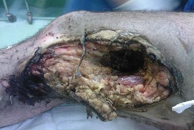 12188-awful-outcome-being-burned-electricity-chemicalsbig0.jpg