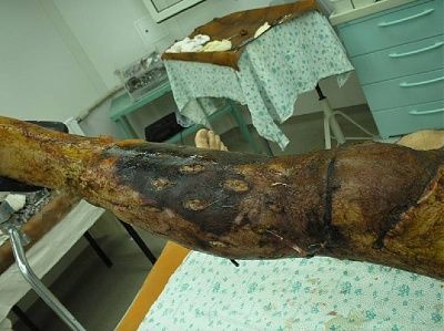 12632-horrifically-burned-legbig1.jpg