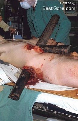 metal-bar-through-man-hip-387x600.jpg