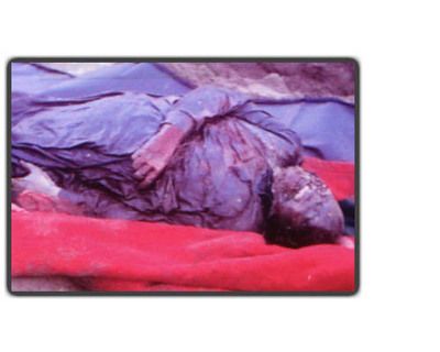 fallujah_white_phosphorous_victim.jpg