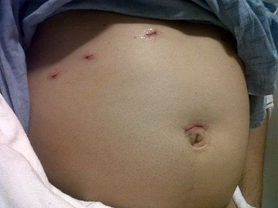 surgery-aftermath.jpg