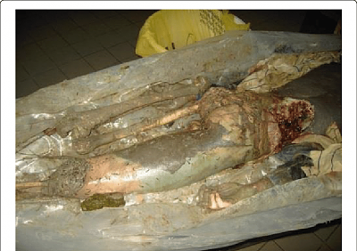 body-decomposition-missing-big-part-its-right-side.png