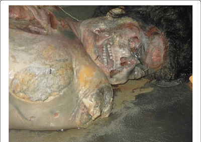 detachment-body-member-cadaver-advanced-putrefaction.png
