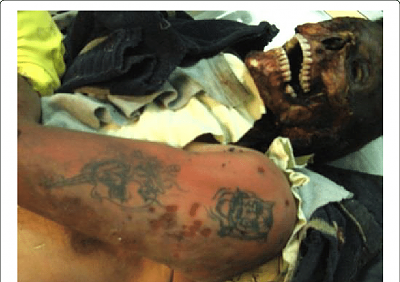 postmortem-arm-marks.png