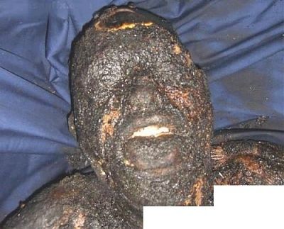 burned-alive-car-accident-01-500x404.jpg