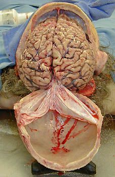 autopsy_brain.jpg