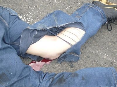 01 scraped knee.jpg