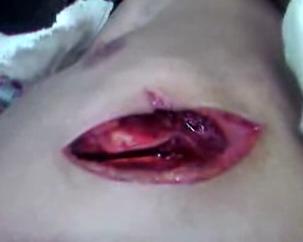 5467-wide-open-stab-wound.jpg
