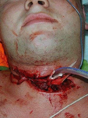 Tracheal_laceration.jpg