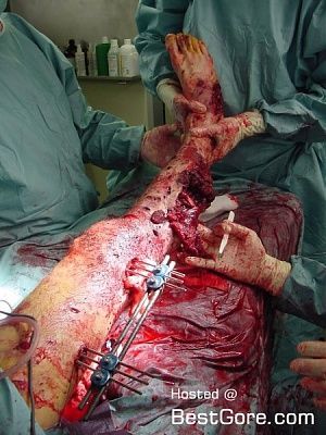severe-leg-trauma-450x600.jpg