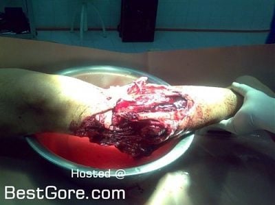fractured-knee-01-500x374.jpg