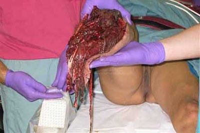 iraqiwomanmissingleg.jpg