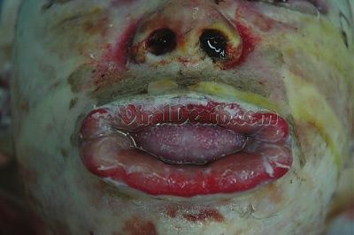 viraldeath_com_burn_victim-519.jpg