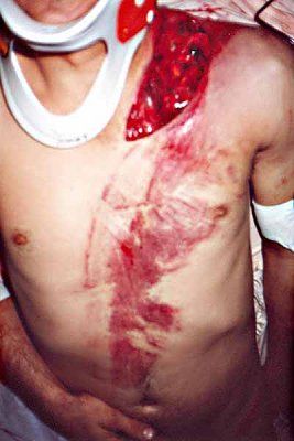 seat-belts-injury-clavicle-open-fracture.jpg