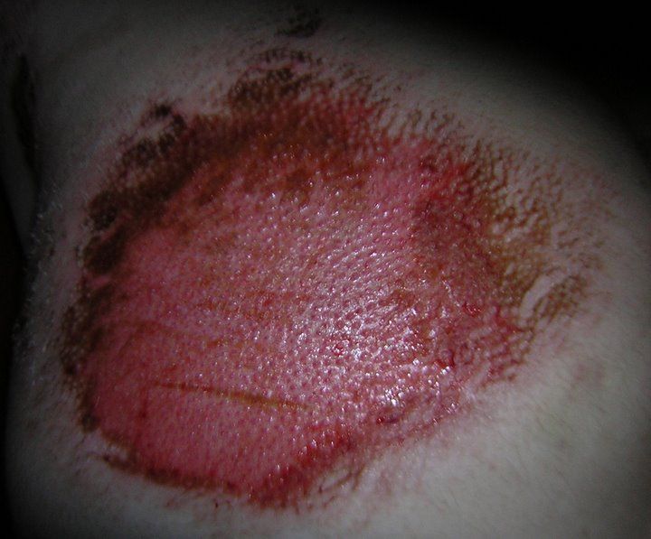 motorcycle-road-rash-pictures- (6).JPG