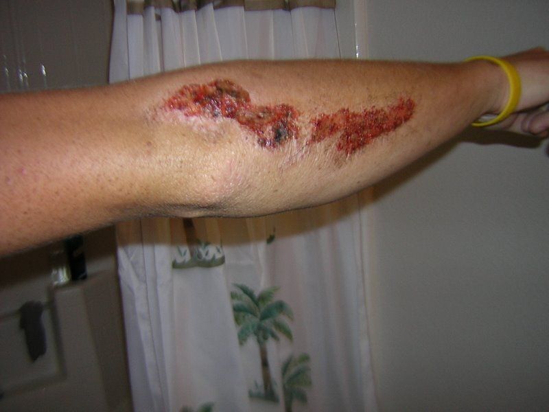 motorcycle-road-rash-pictures- (5).JPG