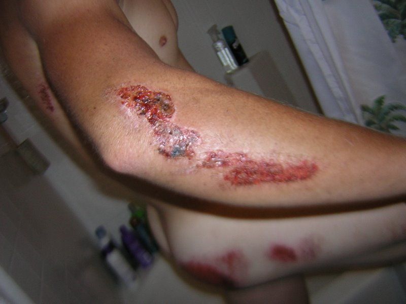 motorcycle-road-rash-pictures- (4).JPG