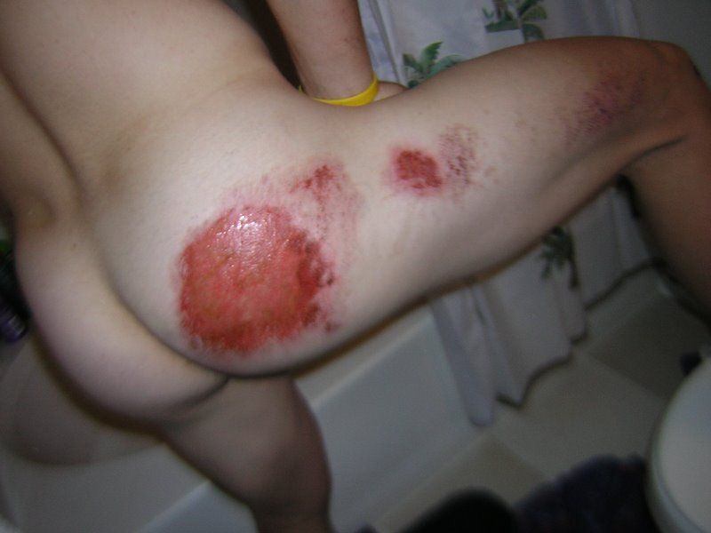 motorcycle-road-rash-pictures- (3).JPG