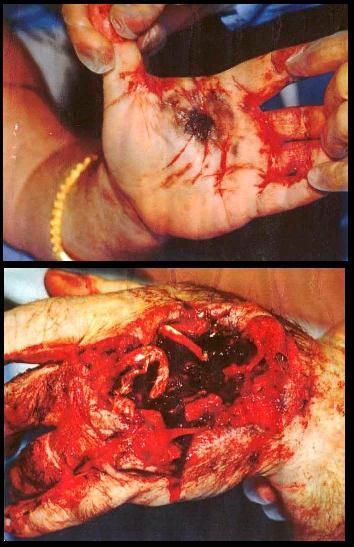 gunshot wound hand accidental.jpg