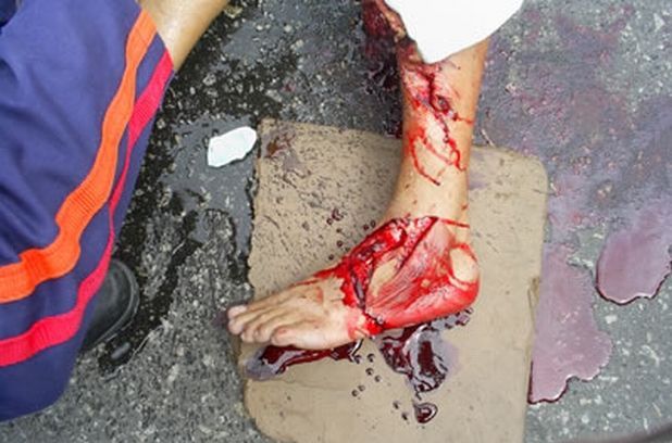 motorcyclist wound 3.jpg