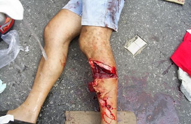 motorcyclist wound 4.jpg
