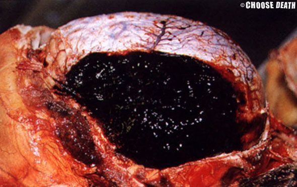 Large parieto-temporal extradural haemorrhage caused by a fracture crossing the middle meningeal.jpg