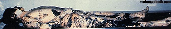 The black discoloration on the skin is mold. This man had been embalmed and buried for over thre.jpg