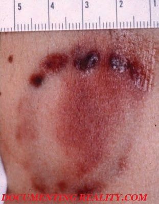 bite-marks.jpg