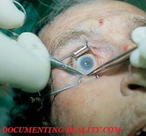 removing-eye.jpg