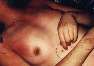 bruised-dead-female.jpg