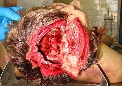 exit-wound-gunshot.jpg