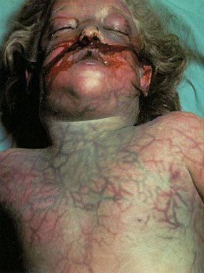 ASPHYX.JPG
